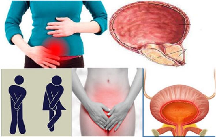 Signs of cystitis in women burning and pain when urinating