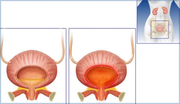 The bladder is normal and with signs of inflammation due to cystitis.